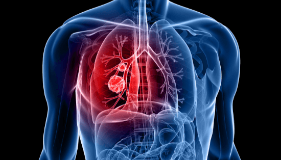 Nódulo Pulmonar